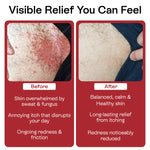 Jock Itch Antifungal Cream for Itching, Redness & Odor Relief