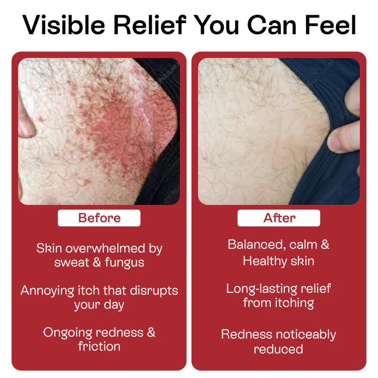 Jock Itch Antifungal Cream for Itching, Redness & Odor Relief