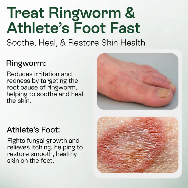 Medicated Antifungal Body Wipes for Ringworm, Jock Itch & Athlete’s Foot