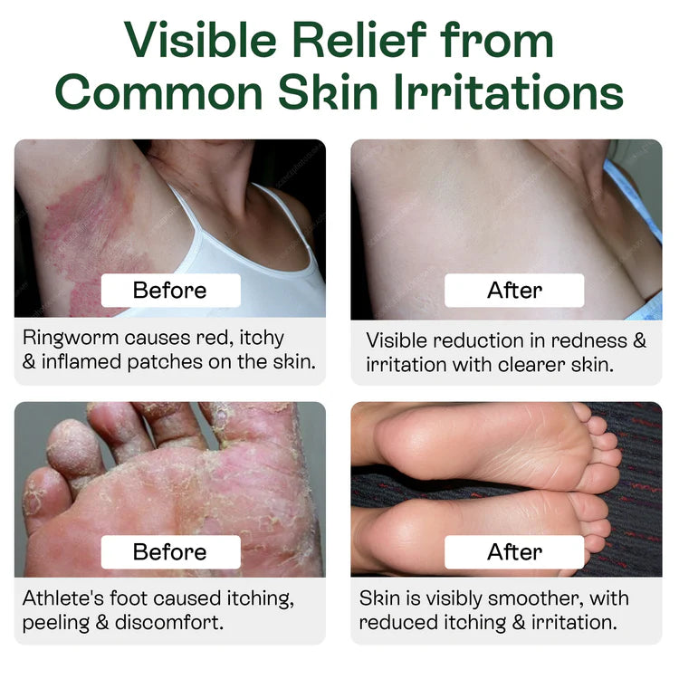 Medicated Antifungal Body Wipes for Ringworm, Jock Itch & Athlete’s Foot