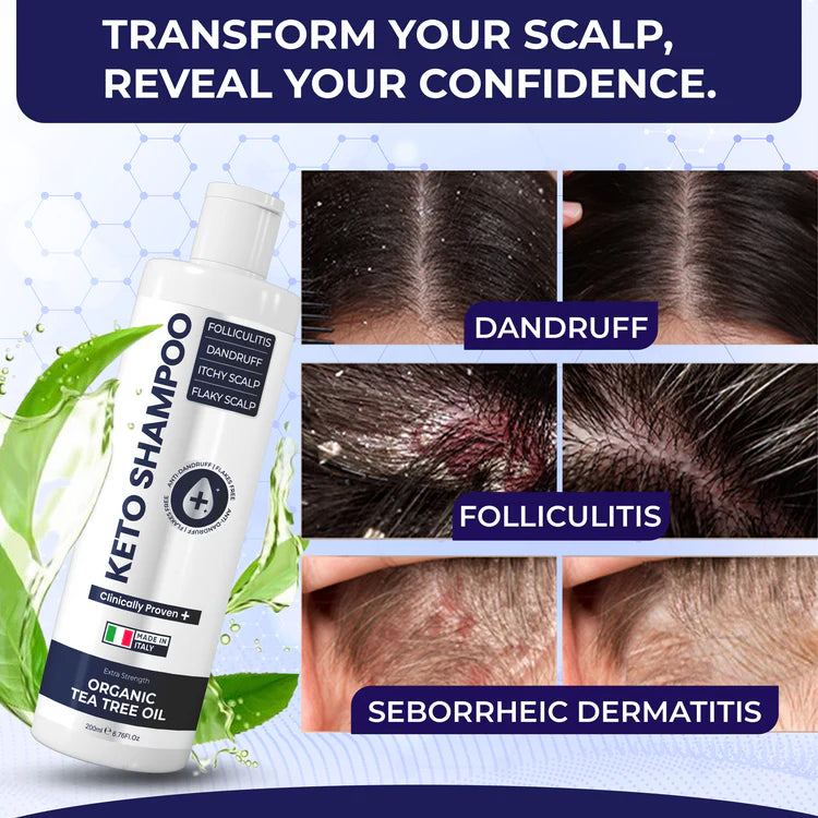 Keto Shampoo for Dandruff, Psoriasis, Folliculitis & Seborrheic Dermatitis | Anti-Fungal Itchy Scalp Relief