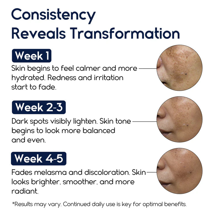Melasma Cream & Dark Spot Remover for Skin Discoloration, Post-Blemish Marks, Scars & Spots