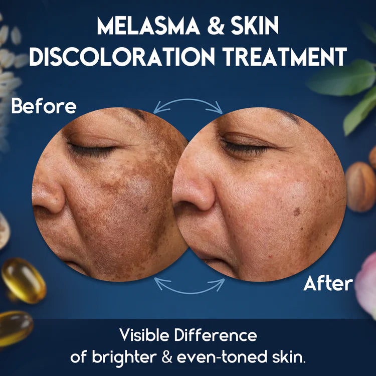 Melasma Cream & Dark Spot Remover for Skin Discoloration, Post-Blemish Marks, Scars & Spots