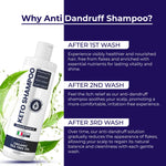 Keto Shampoo for Dandruff, Psoriasis, Folliculitis & Seborrheic Dermatitis | Anti-Fungal Itchy Scalp Relief