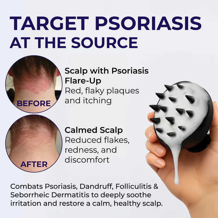 Keto Shampoo for Dandruff, Psoriasis, Folliculitis & Seborrheic Dermatitis | Anti-Fungal Itchy Scalp Relief