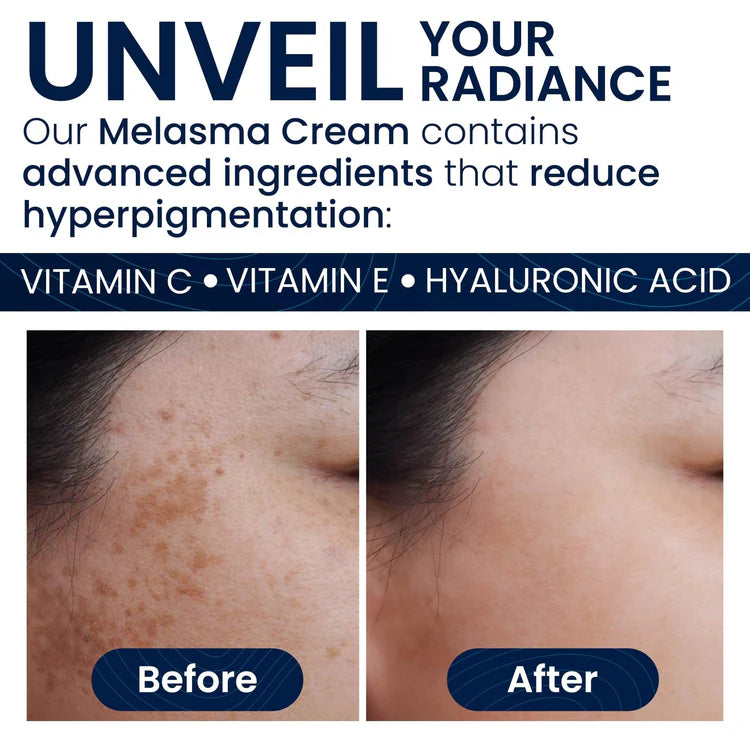 Melasma Cream & Dark Spot Remover for Skin Discoloration, Post-Blemish Marks, Scars & Spots